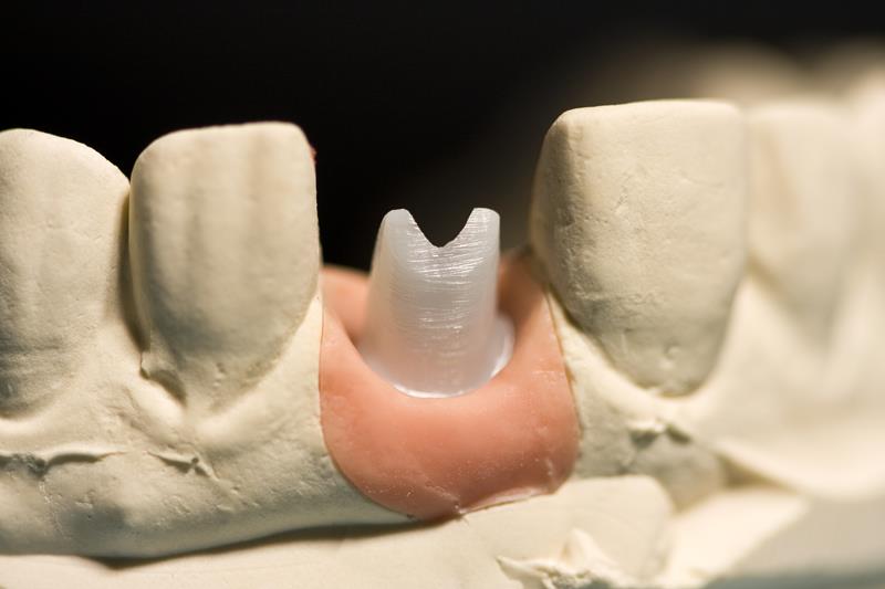 Implant Restoration  Tracy, CA