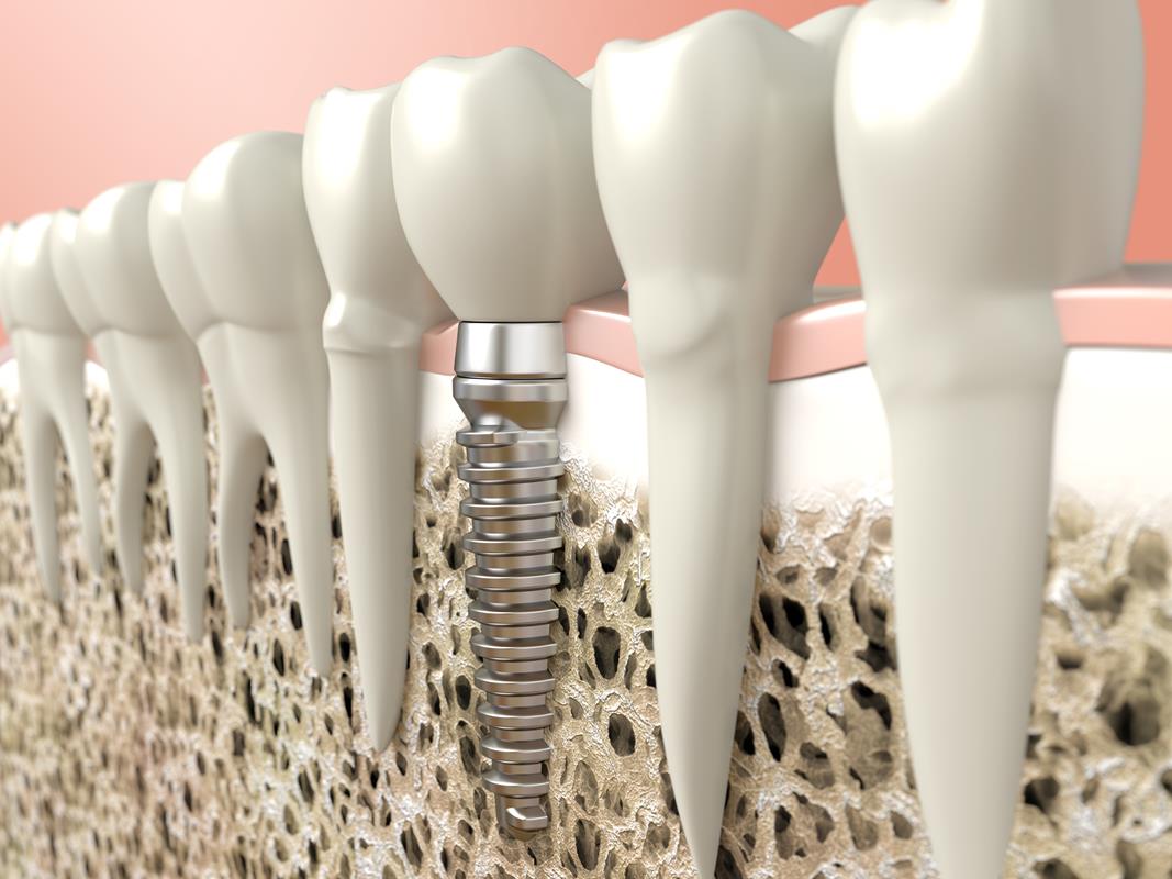 Dental Implants Tracy, CA