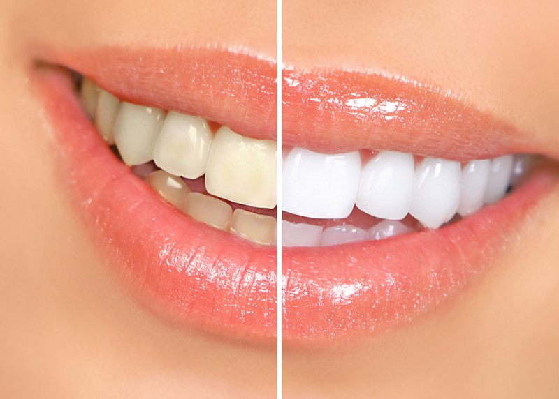 Teeth Whitening  Tracy, CA