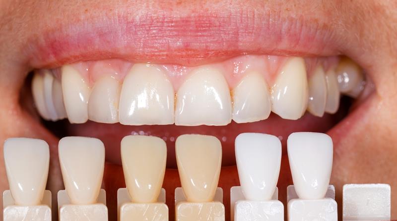 Veneers Tracy, CA